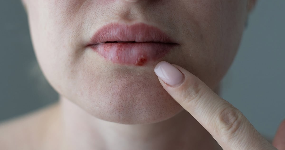 Aprueban en Estados Unidos un antiviral oral inédito para herpes resistente en pacientes inmunocomprometidos