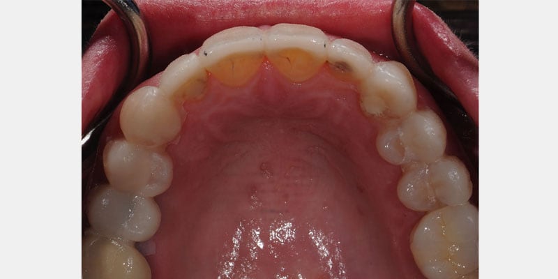 Carillas dentales: cómo advertir filtraciones en los márgenes antes de que comprometan la pieza